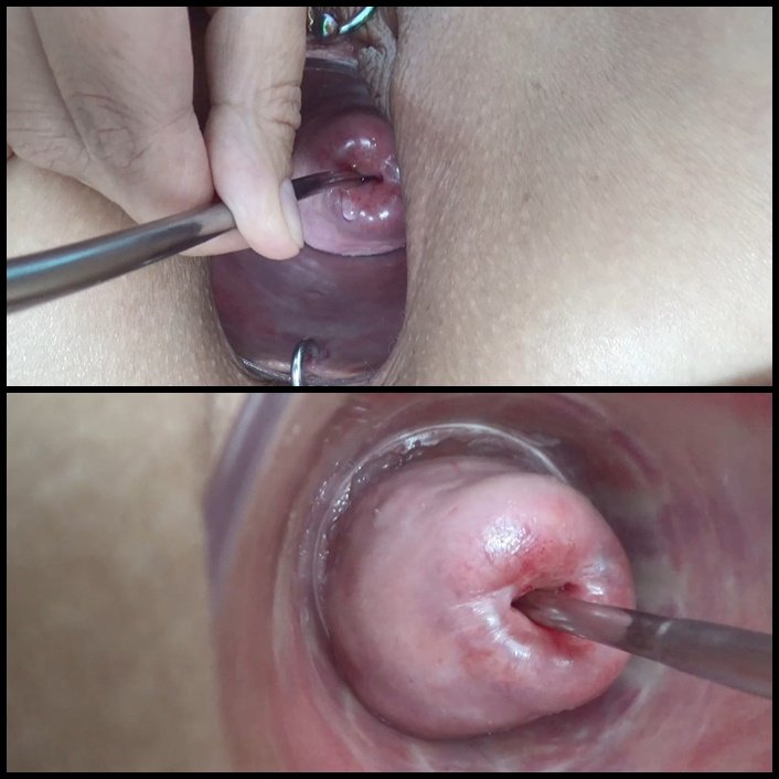Open cervix